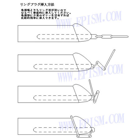 尿道リングプラグの装着方法